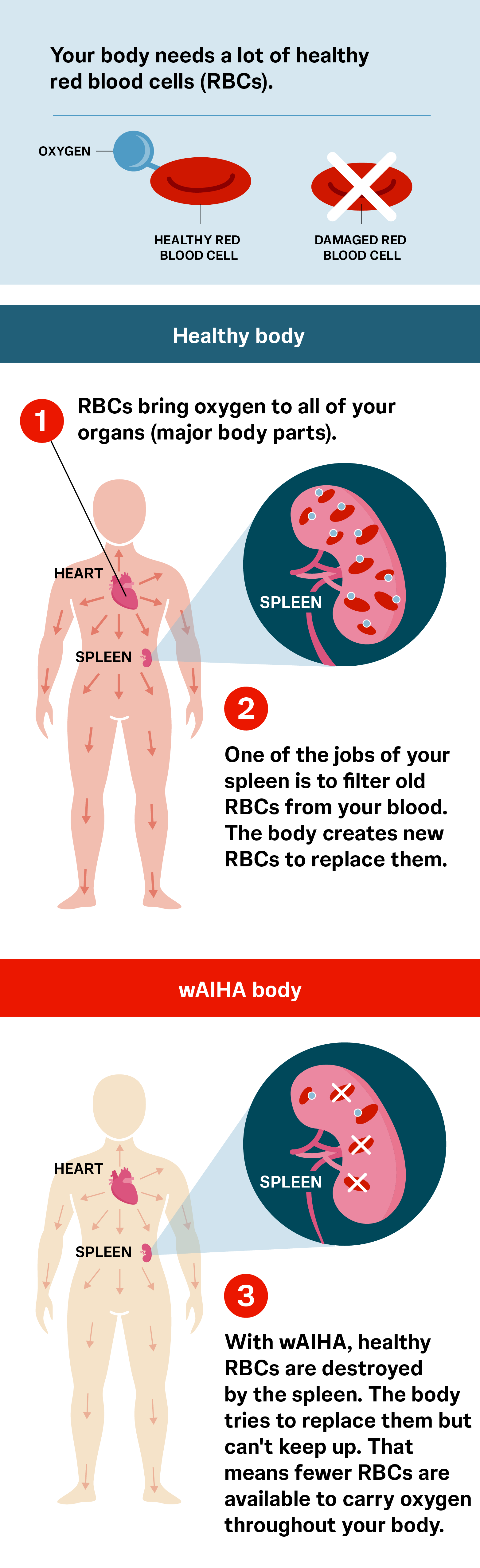 red blood cell with an oxygen molecule and an icon of a red blood cell with an "X" over it the human body with a focus on the spleen showing the difference between normal spleen interaction with red blood cells and increased red blood cell destruction because of wAIHA. Three main points are written out: 1) RBCs bring oxygen to all of your organs (major body parts). 2) One of the jobs of your spleen is to filter old RBCs from your blood. A normal amount of RBCs get moved through your body. 3) With wAIHA, healthy RBCs are destroyed by the spleen. That means fewer RBCs get moved through your body.