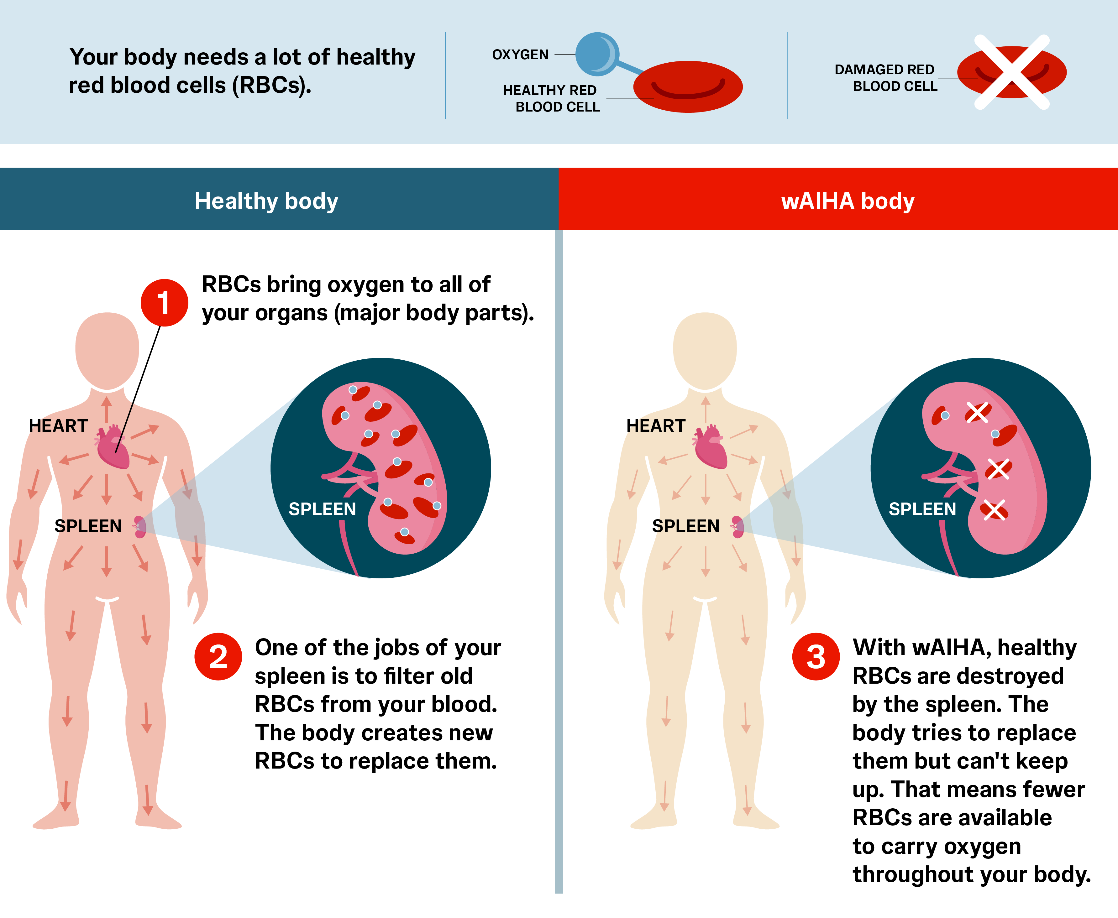 red blood cell with an oxygen molecule and an icon of a red blood cell with an "X" over it the human body with a focus on the spleen showing the difference between normal spleen interaction with red blood cells and increased red blood cell destruction because of wAIHA. Three main points are written out: 1) RBCs bring oxygen to all of your organs (major body parts). 2) One of the jobs of your spleen is to filter old RBCs from your blood. A normal amount of RBCs get moved through your body. 3) With wAIHA, healthy RBCs are destroyed by the spleen. That means fewer RBCs get moved through your body.